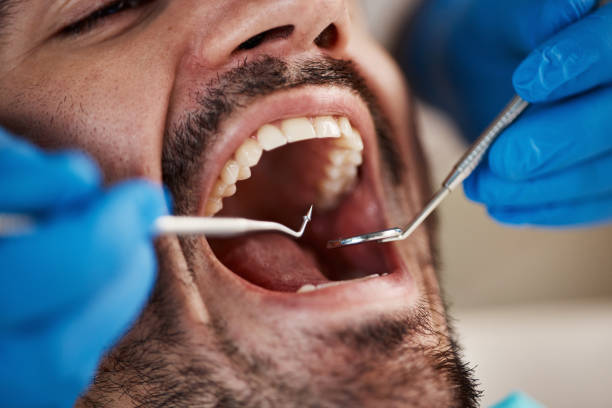 Best Emergency Treatment for Dental Infections or Abscesses in West Liberty, OH