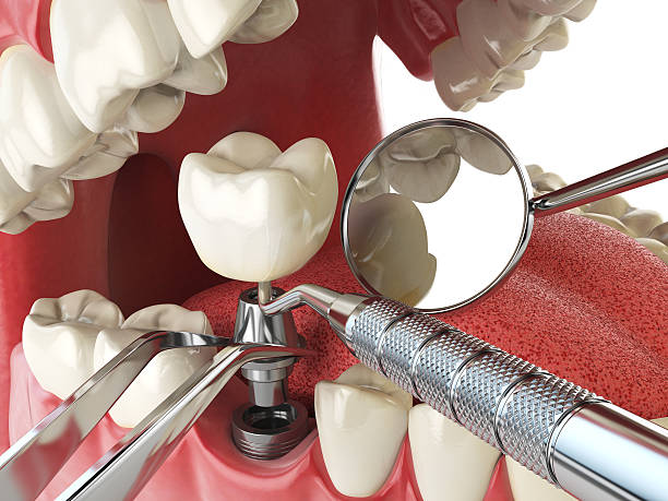 Best Emergency Dental Care for Broken or Chipped Teeth in West Liberty, OH